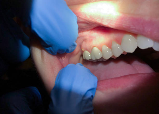 Best Emergency Wisdom Teeth Removal in Port Dickinson, NY
